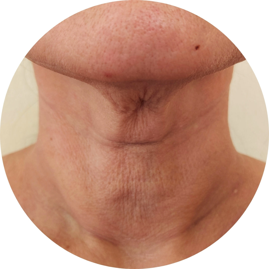 Anti-Falten Starter Set - Glowholic Micro-Needling Infusion für zuhause