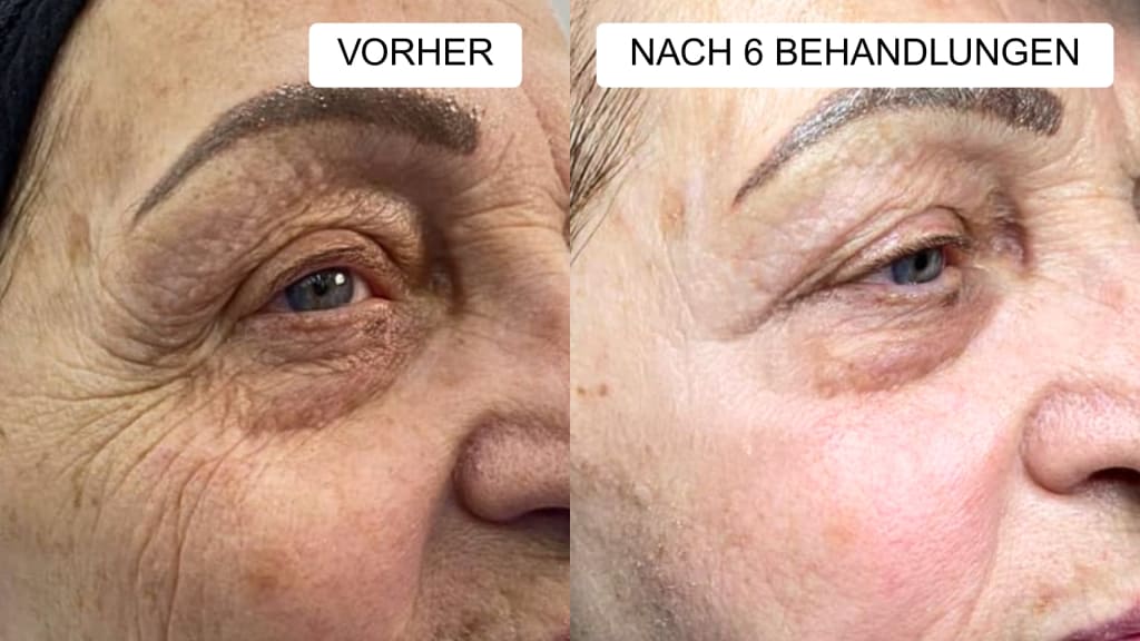 Anti-Falten Starter Set - Glowholic Micro-Needling Infusion für zuhause