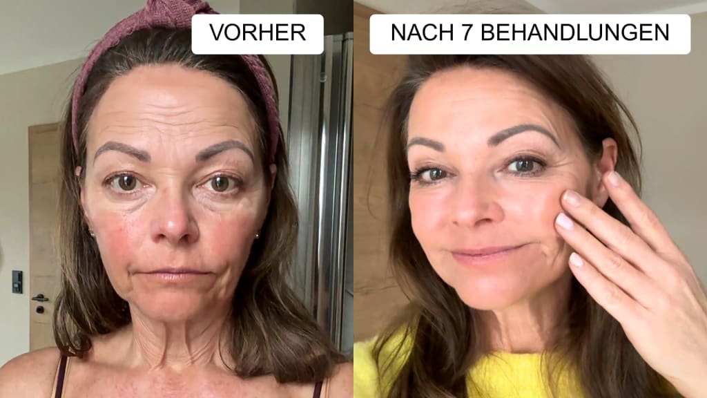 Anti-Falten Starter Set - Glowholic Micro-Needling Infusion für zuhause