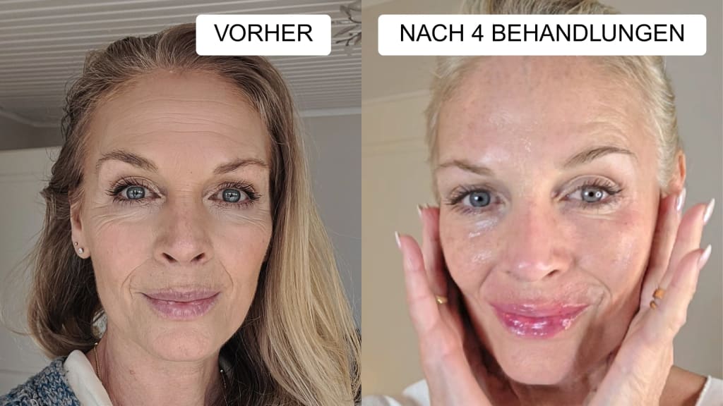 Anti-Falten Starter Set - Glowholic Micro-Needling Infusion für zuhause