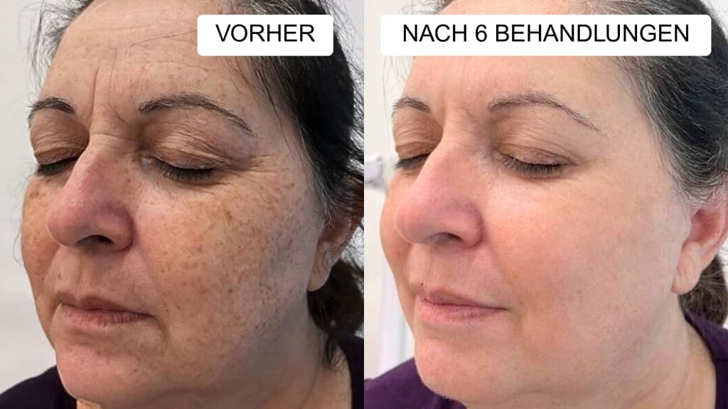 Anti-Falten Starter Set - Glowholic Micro-Needling Infusion für zuhause