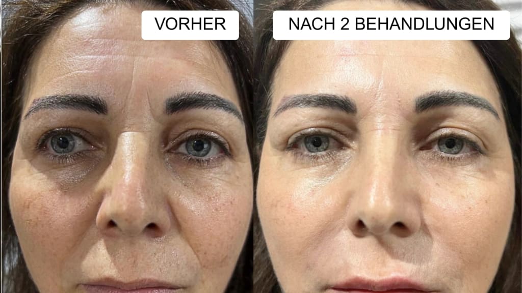 Anti-Falten Starter Set - Glowholic Micro-Needling Infusion für zuhause